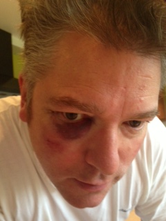 Towns Bruised Face
